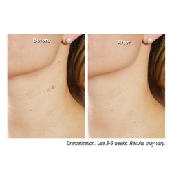 ElimiTag-Skin Tag Remover - 2 Bottles&nbsp;&nbsp;Model#&nbsp;ET15