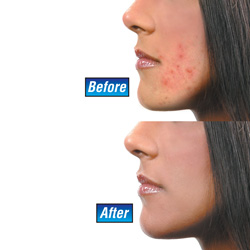 Dermabrite Light Therapy&nbsp;&nbsp;Model#&nbsp;LT01G